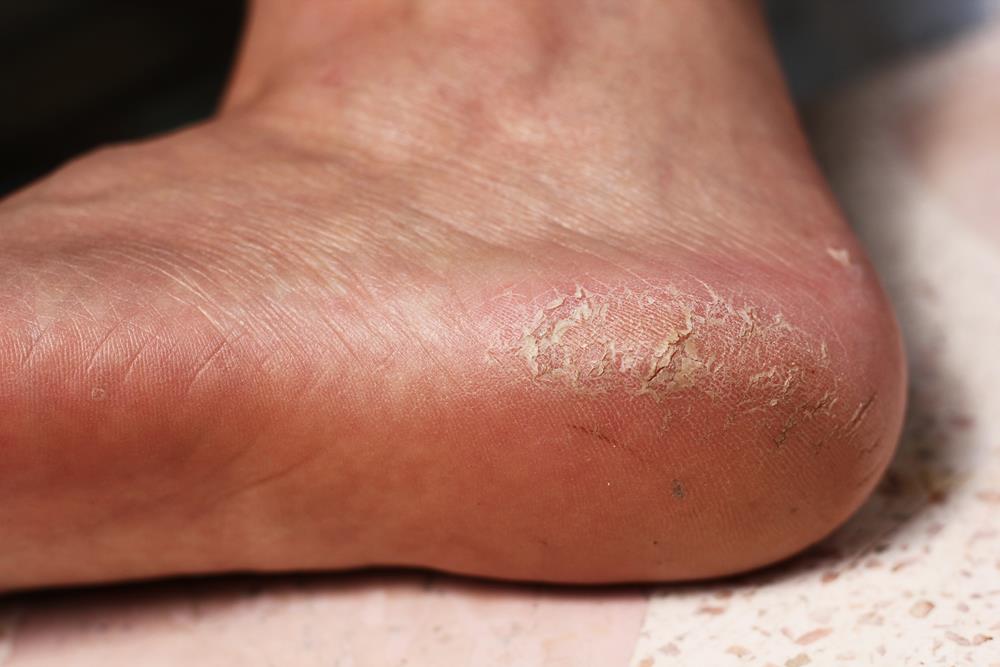 Calluses Atlanta and the surrounding counties