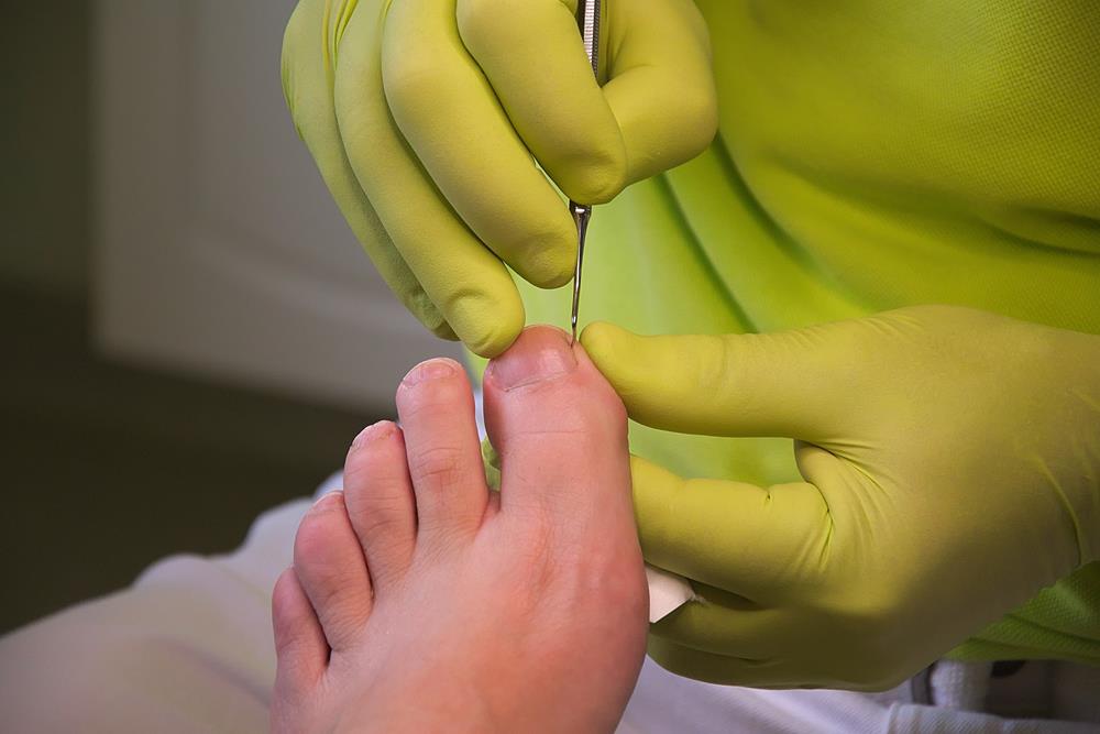 Ingrown Toenails Atlanta and the surrounding counties